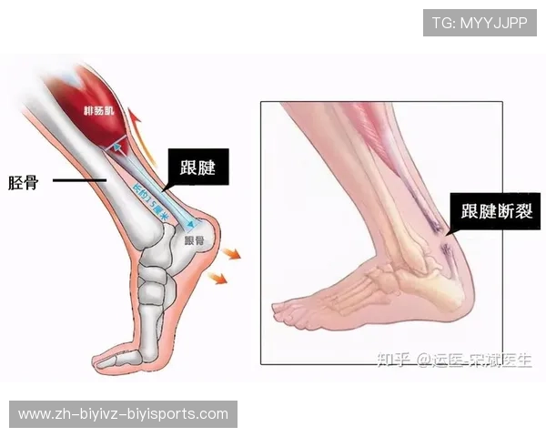 羽毛球耗跟腱 羽毛球耗跟腱